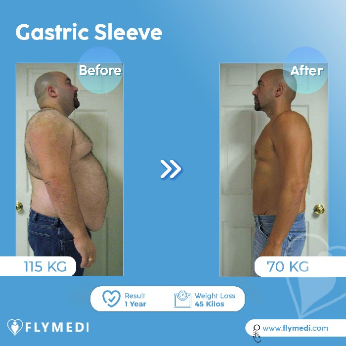Flymedi Gastric Sleeve Review